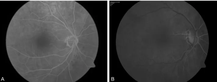 Figure 1. The pattern of watershed zone in fluorescence angiography. (A) 65-year-old female NTG patient shows that watershed  zone is not including the optic nerve head