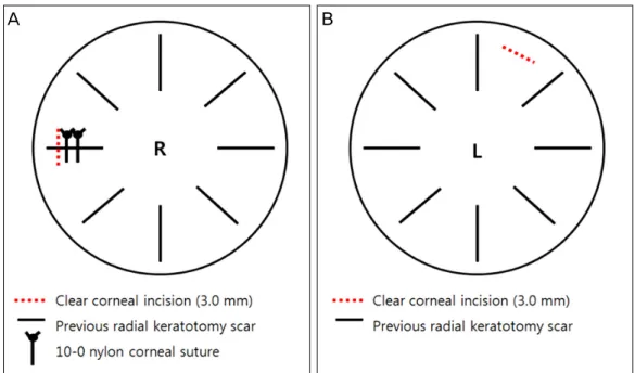 Figure 1. For the surgery of the right eye, a clear corneal incision was made with temporal approach over  previous radial keratotomy incision site (A)