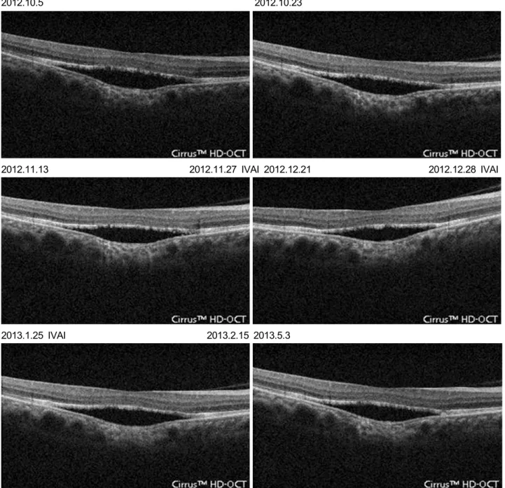 Figure 2. Right eye optical coherence tomography (OCT) represents thick hyperreflective structures in the retinal pigment epi- epi-thelium (RPE) layer and serous retinal detachment and subretinal fluid