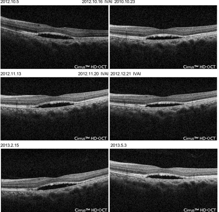 Figure 3. Left eye optical coherence tomography (OCT) also represents abnormal findings as described above on the right eye