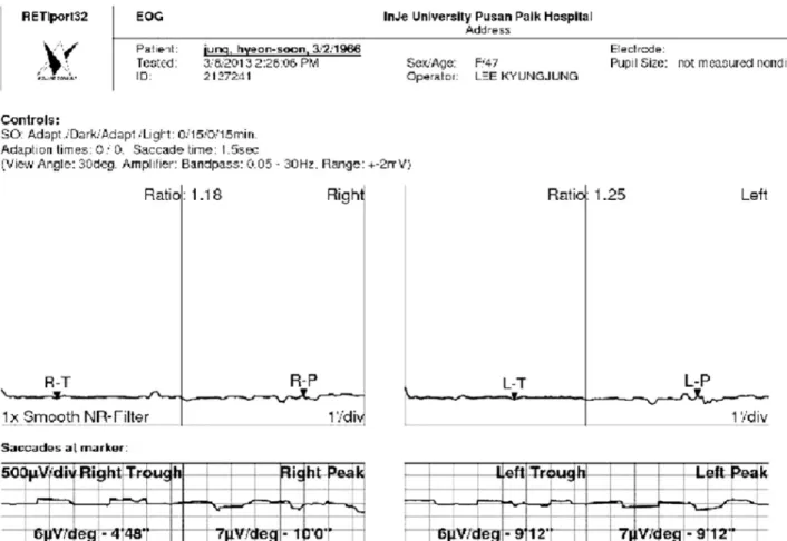 Figure 4. Electrooculography (EOG) showed decrease in the Arden ratio (light-dark ratio), 1.16 in the right eye and 1.25 in the left eye