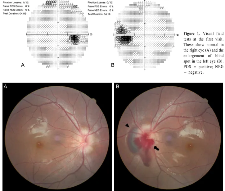 Figure 1. Visual field  tests at the first visit. 