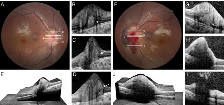 Figure 3. Images showing multiple buried optic disc drusen within small optic disc of the right eye (A-E) and left eye (F-J)