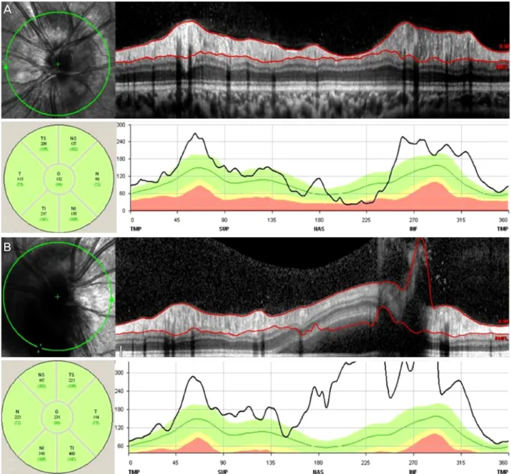 Figure 4. Retinal nerve fiber layer (RNFL) measurement using spectralis optical coherence tomography (OCT) of both eyes