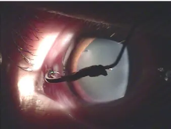Figure 2. Slit lamp microscope photograph of patient showing  perforated sclera by fish hook