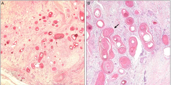 Figure 3. Hematoxylin and eosin stain shows clusters of squamous cells with polymorphic nucleus and interspersed keratin pearls  (arrow), consistent with findings of well-differentiated squamous cell carcinoma (A: ×40; B: ×200).