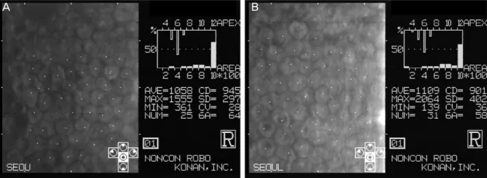 Figure 3. Specular microscopy of the right eye showed a low endothelial count (945 and 901 cells/mm 2 ) as well as endothelial cells  of variable shape and size (polymorphism and polymegathism)