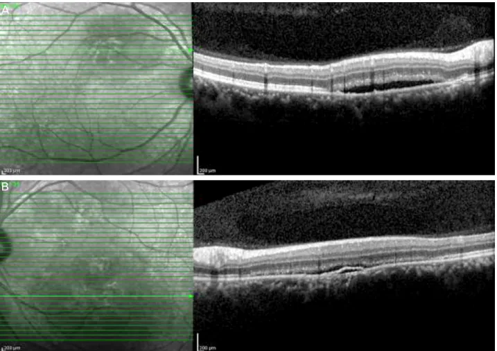 Figure 3. At 24 days after trauma, optical coherence tomography shows decreased subretinal fluid in both eyes (A, B)