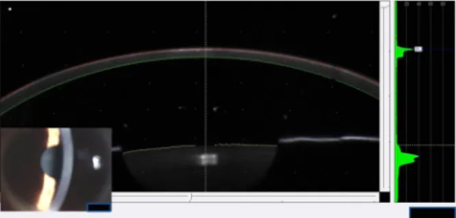 Figure 1. Scheimpflug image and slit-lamp photograph of a  cornea after PRK.과가 입증되었다.10,11트라닐라스트는 임상적으로 항 알러지 제재로 혈관투과성 억제 및 비만세포로부터의 histamine과 leukotriene의 길항을 통한 항 염증작용 이외에도 TGF-β를 억제하여 각막실질세포의 증식을 억제하고 교원질 같은 세포외기질의 분비 빛 축적을  억제하여  각막혼탁을  감소시킨다고  알려졌다.