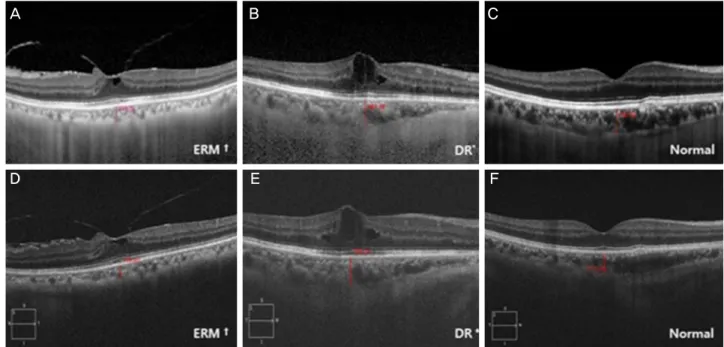 Figure 1. Optical coherence tomography (OCT) scans showing choroidal thicknesses of the same subject on two different systems