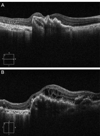 Figure 2. The optical coherence tomography (OCT) images of  84-year-old male patient with continuing anti-VEGF treatment  after retinal pigment epithelium (RPE) tear