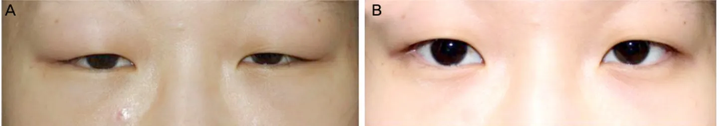 Figure 1. (A) Erythematous swelling of both the upper eyelids at the first visit. (B) No relapse of dacryoadenitis at 3 months after  conservative therapy