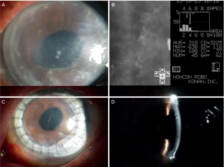 Figure 1. (A) Host cornea before surgery. (B) Corneal endothelium microscopy before surgery (the figure 3225 in the result was  miscounted)