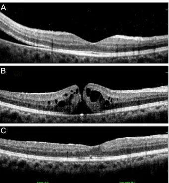 Figure 1. Optical coherence tomography images of patient  number 12 that were taken at the diagnosis of retinal  detach-ment (macular-spared) (A), 22 months after rhegmatogenous  retinal detachment repair, macular hole had developed (B)