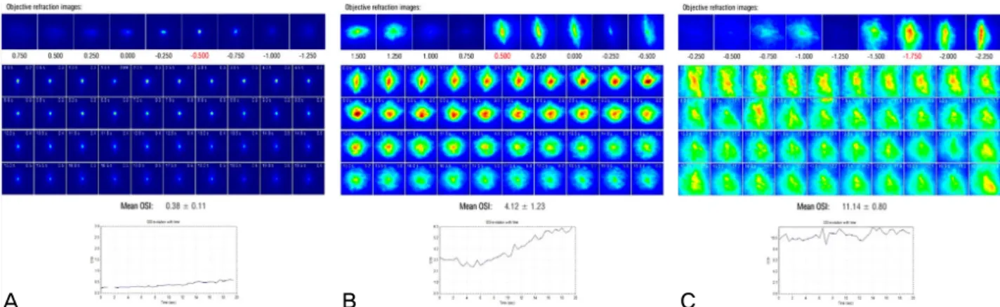 Figure 4. Result papers from continuous recording of double pass retinal image. (A) Normal control patient without dry eye  symptoms