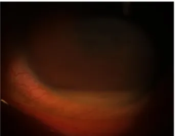 Figure 1. Representative image of slit lamp photograph shows  conjunctival injection and hypopyon (case 8).