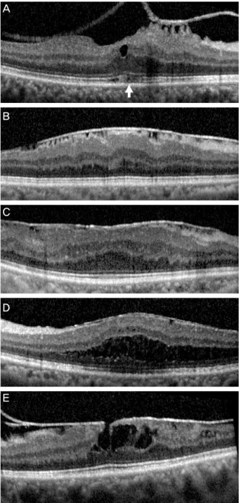 Figure 2. Spectral domain optical coherence tomography (SD-  OCT) images of preoperative macular structure deformities