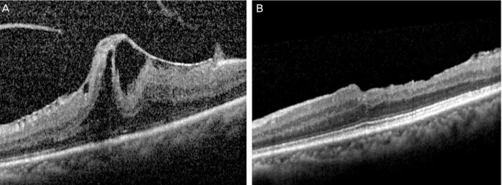 Figure 4. Spectral domain optical coherence tomography (SD-OCT) image changes after surgery of the same eye as in Fig