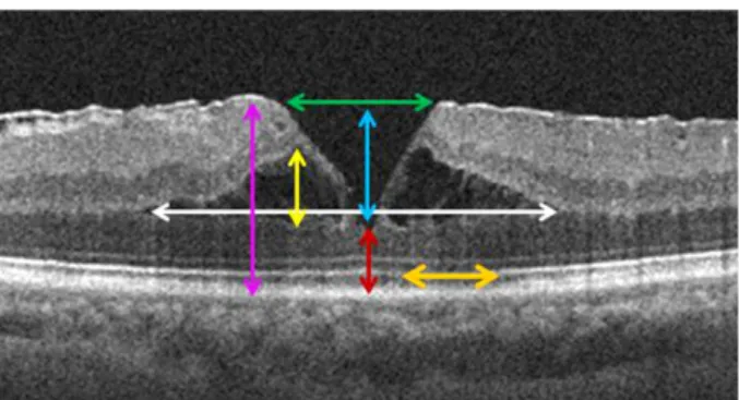 Figure 1. Presumed prognostic factor of spectral-domain opti- opti-cal coherence tomography