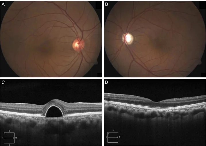 Figure 1. Preoperative fundus photograph reveals (A) a focal elevated lesion at macula in right eye (B) and slightly pale optic disc  and no definite abnormal findings of macula in left eye