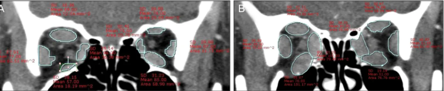 Figure 1. (A) Orbital CT scan for a patient who had orbital decompression of both orbits
