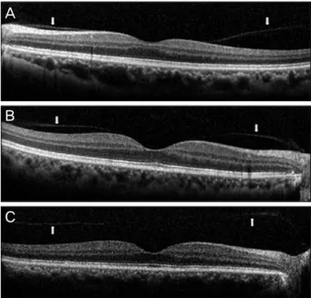 Figure 2. Incomplete VMS: SD OCT images for eccentric  VMS (A), and perifoveal VMS (B), and shallow VMS (C)