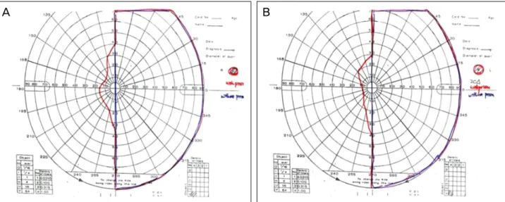 Figure 1. Visual fields have been expanded from the seeing side into the defected side after using prisms on a 27 years old male pa- pa-tient with left side homonymous hemianopsia