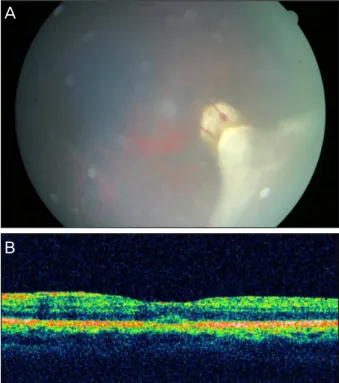 Figure 3. (A) W ell visualized retinal mass through relative  clear vitreous cavity 1 month after subtenon’s triamcinolone  aceteonide injection