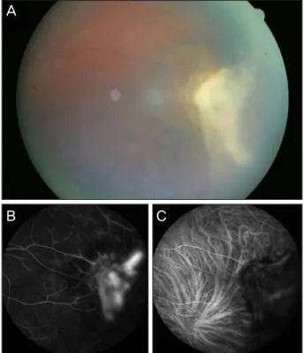 Figure 4. (A) Homogenous creamy yellow colored mass in in- in-ferotemporal peripheral retina