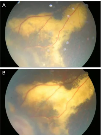 Figure 6. (A) Homogenous creamy yellow colored fine mass  with surrounding exudates and photocoagulation scar in  in-feronasal peripheral retina