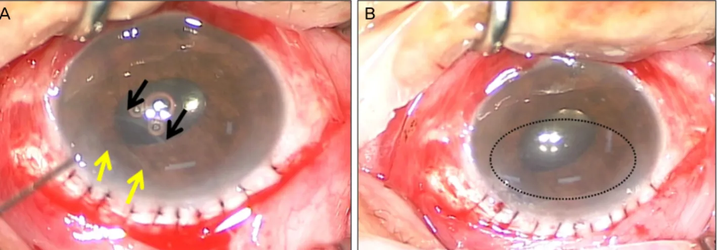 Figure 1. Descemet membrane detachment during extracapsular cataract surgery. (A) Descemet membrane tear (yellow arrows) at  the mid-periphery cornea due to insertion of instruments