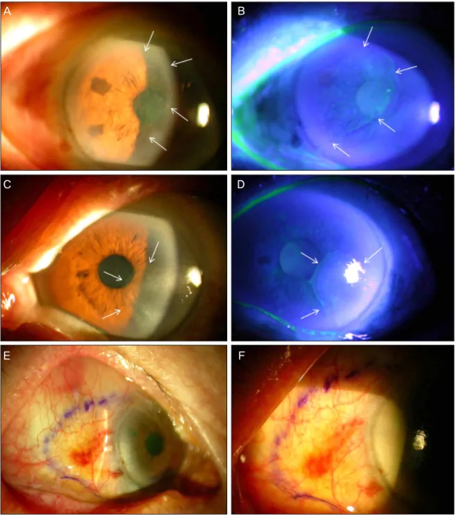 Figure 1. (A, B) Anterior segment photograph of right eye before surgery. Well demarcated the opaque lesion covering half  of the corneal surface and extensively involving the visual axis