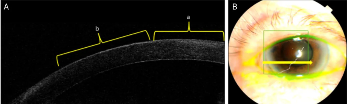 Figure 2. (A) Anterior segment OCT image of the cornea between the normal cornea (a) and CIN lesion (b)