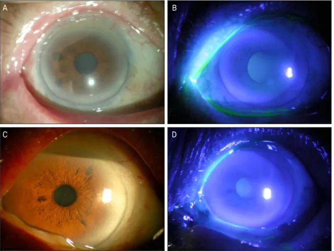Figure 4. Anterior segment photograph of the right eye (A, B) and left eye (C, D) after 8 months of surgery exhibiting com- com-plete remission of conjunctival and corneal intraepithelial neoplasia