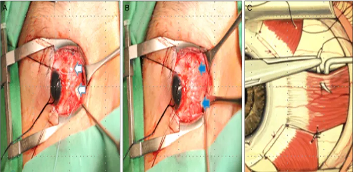 Figure 5. Buckley procedure. Buckley procedure uses a nonabsorbable suture to attach the edges of transposed muscle to the resected muscle