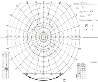Figure 8. Goldman perimetry taken at 6 weeks after second  surgery. Improvement in the area of diplopia area was noted