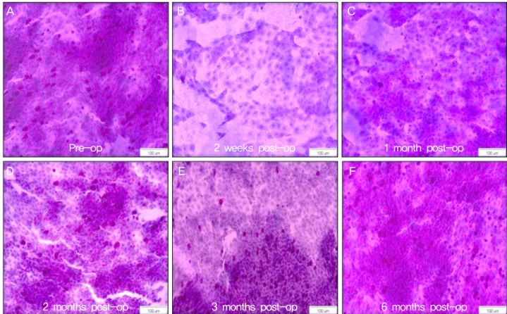 Figure 1. Impression cytological finding of goblet cell density before and after advanced surface ablation