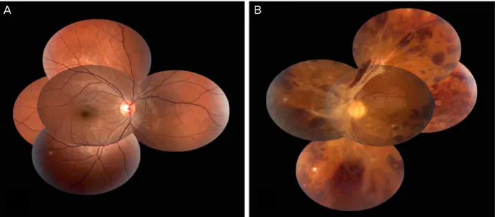 Figure 3. Fundus photographys 3 months after initial visit. (A) Fundus photograph of right eye shows no active lesion