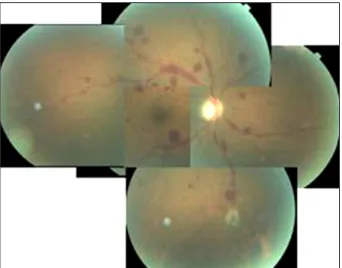 Figure 3. Blocked fluorescences at multiple round retinal hem- hem-orrhage sites are seen