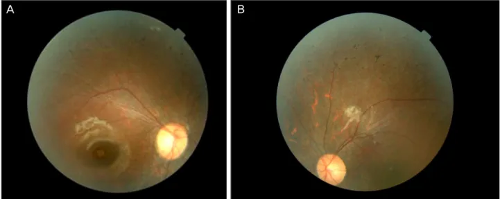 Figure 1. Fundus photographs show scattered bone-spicule formations, peripheral retinal depigmentation, and the retinal vessel  changes in both eyes (A, B).