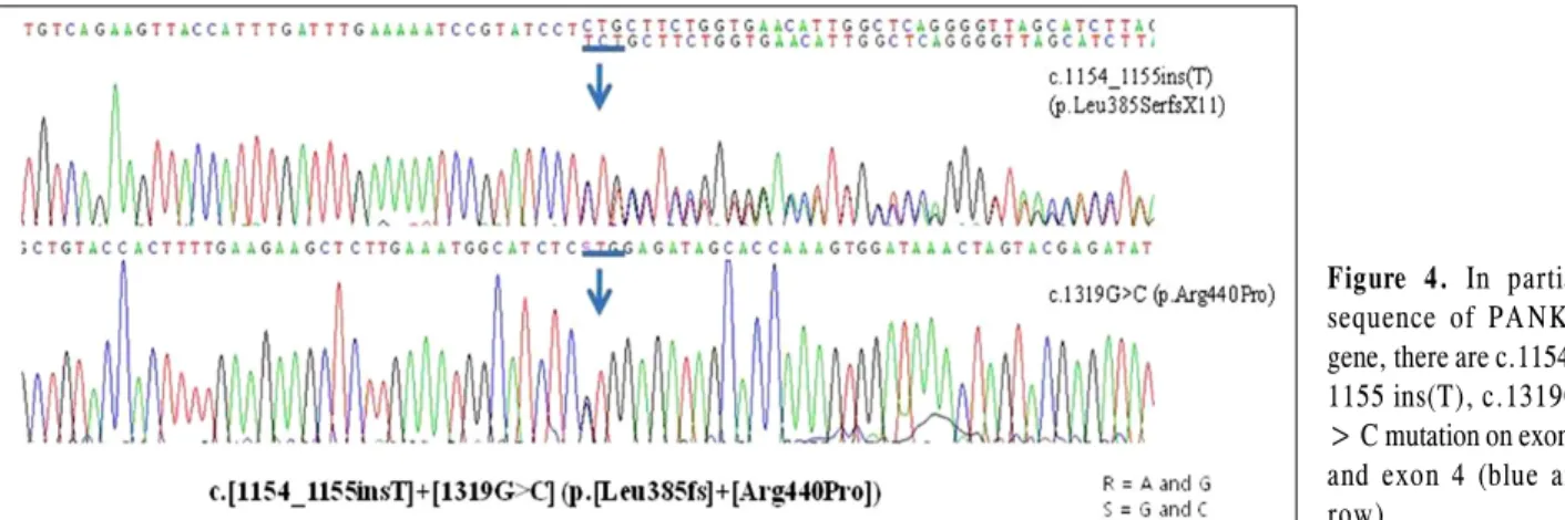 Figure 4. In partial  sequence of PANK2  gene, there are c.1154_