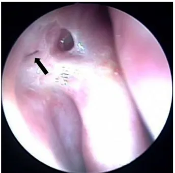 Figure 2. Two weeks after silicone tube removal, inflammation of osteotomy site is subsided (black arrow).