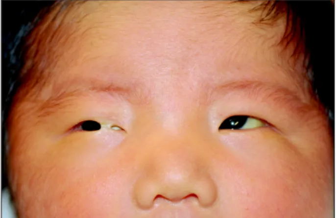 Figure 1. An extensile band of tissue connecting the upper and  lower eyelids of the right eye.