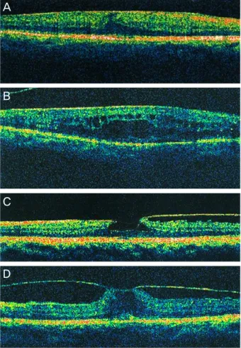 Figure 1. The type of macular epiretinal membrane (ERM) in  OCT images. (A) The DIF type: The DIF type shows globally  adherent membrane widely covering macular area in the  sur-face of retina, diffuse edema and increasing retinal thickness,  (B) The CME t