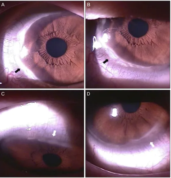 Figure 2. (A, B) Right eye, (C, D) Left eye. Photographs show the state of the eyes 3 months after cataract extraction