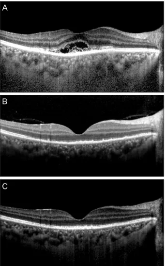 Figure 2. Horizontal section of spectral-domain optical coher- coher-ence tomography images (A) Image at initial visit using  en-hanced-depth image mode