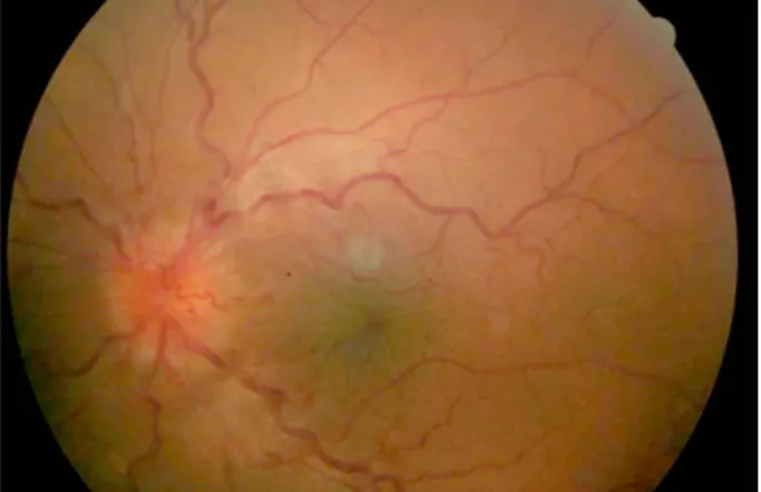 Figure 1. Case 4. Fundus photography of the patient's left eye. 