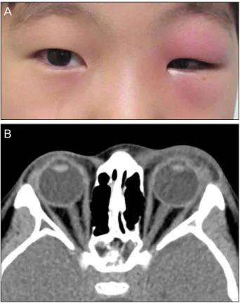 Figure 4. External photograph (A) and CT scan (B) of case 7. 
