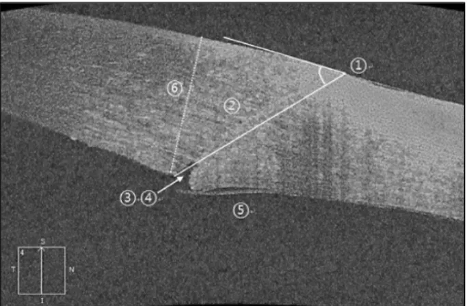 Figure 1. Anterior segment OCT (optical coherence tomography)  image showing a clear corneal incision site postoperatively