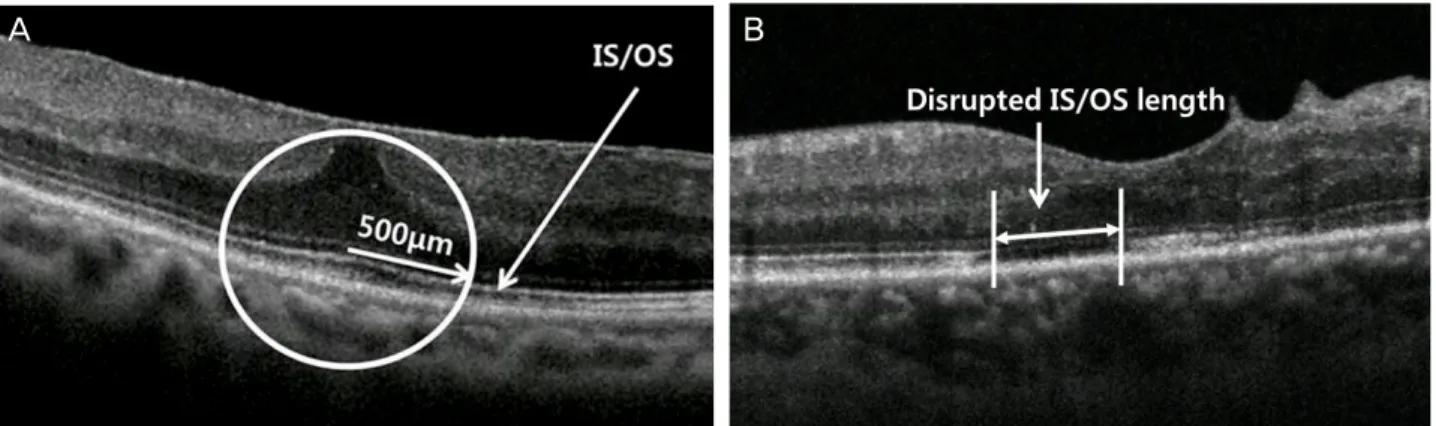 Figure 1. Representative figures of groups according to the integrity of junction between photoreceptor inner and outer segment  (IS/OS) within 500 μm from the center of fovea